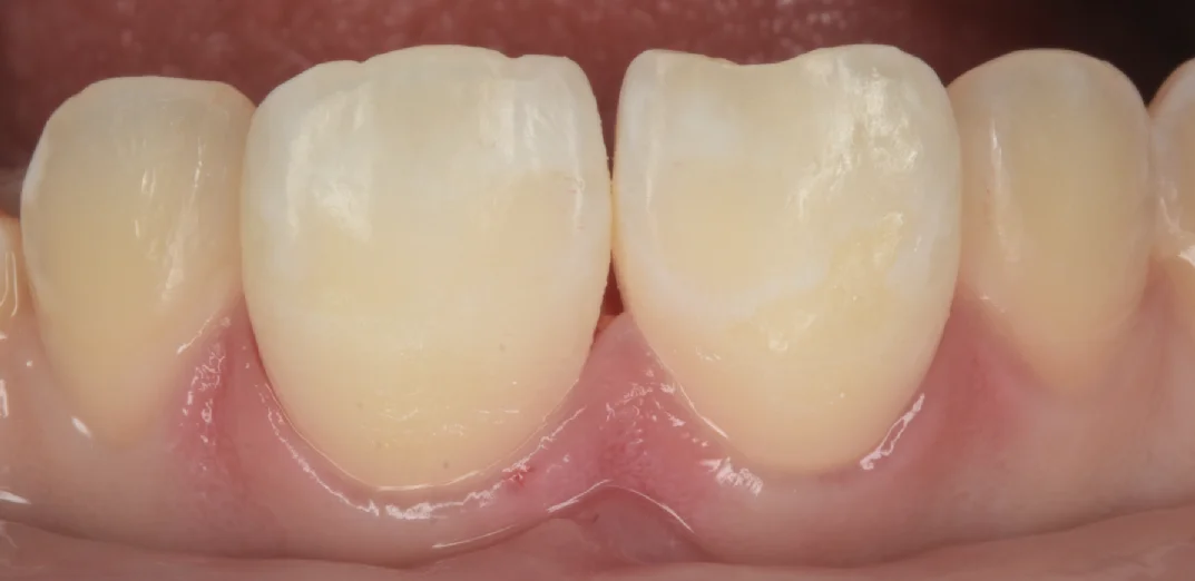 遠方よりICON治療を求めて・・・｜坂寄歯科医院（取手市藤代） - 画像4