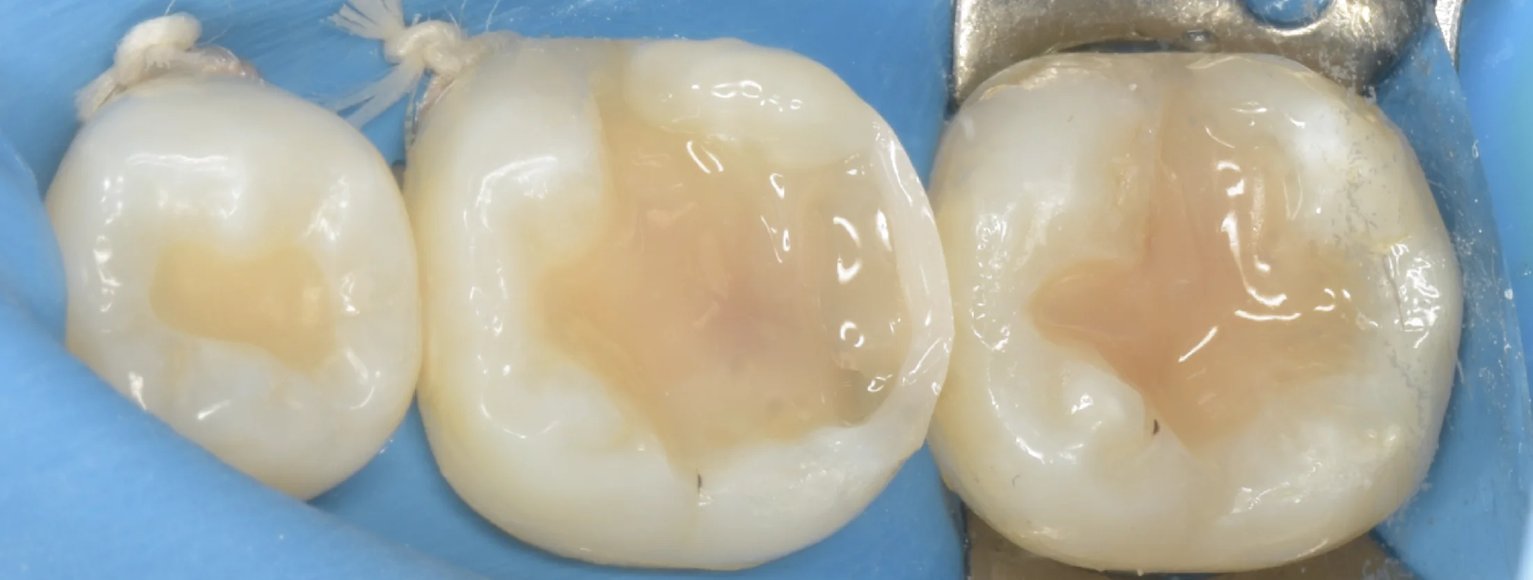 歯科医師の方のCAD/CAMインレーを治療。|坂寄歯科医院(取手市藤代) - 画像6