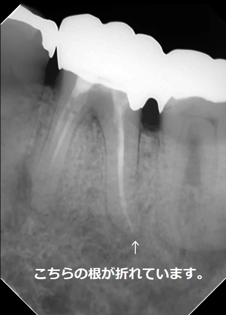 その抜歯ちょっと待って！｜坂寄歯科医院（取手市藤代） - 画像2