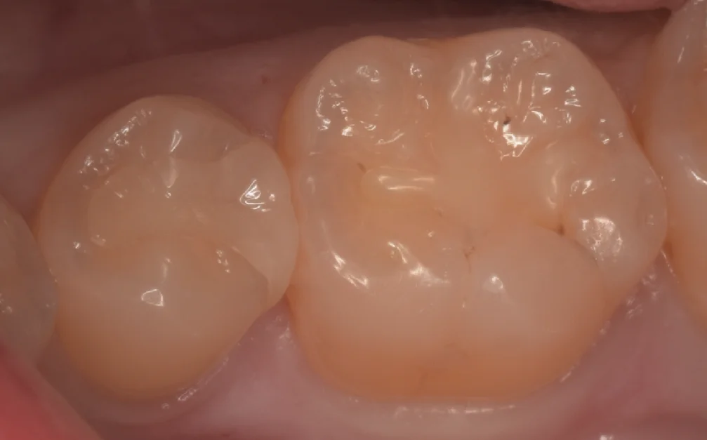 歯科医師の歯を1日で本物の歯のように。|坂寄歯科医院(取手市藤代)