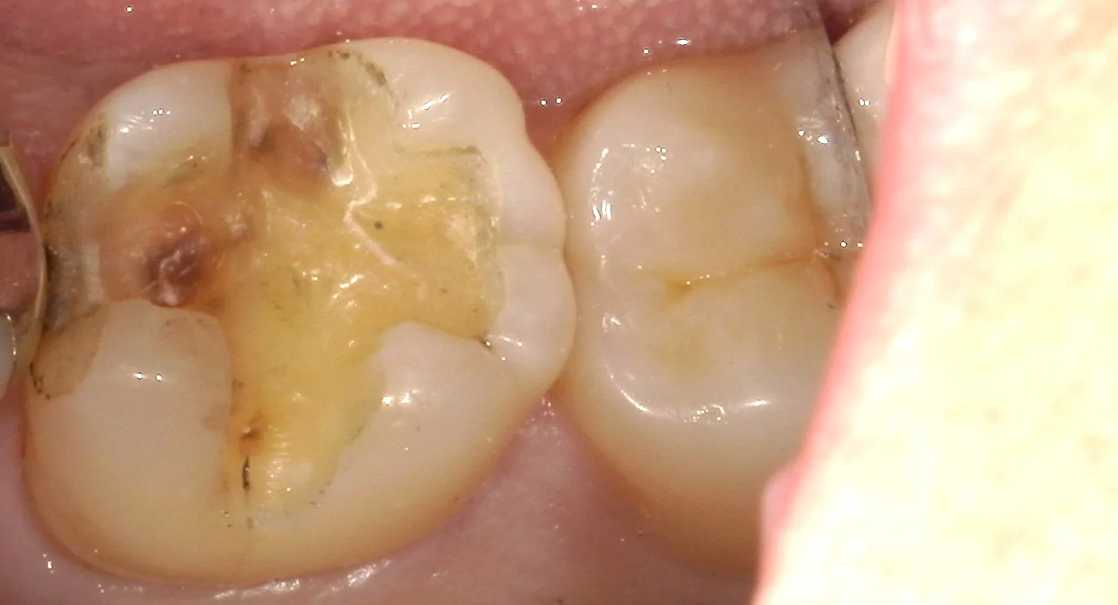 奥歯の自費の白い詰め物。術後数週間後もあります。|坂寄歯科医院(取手市藤代) - 画像2