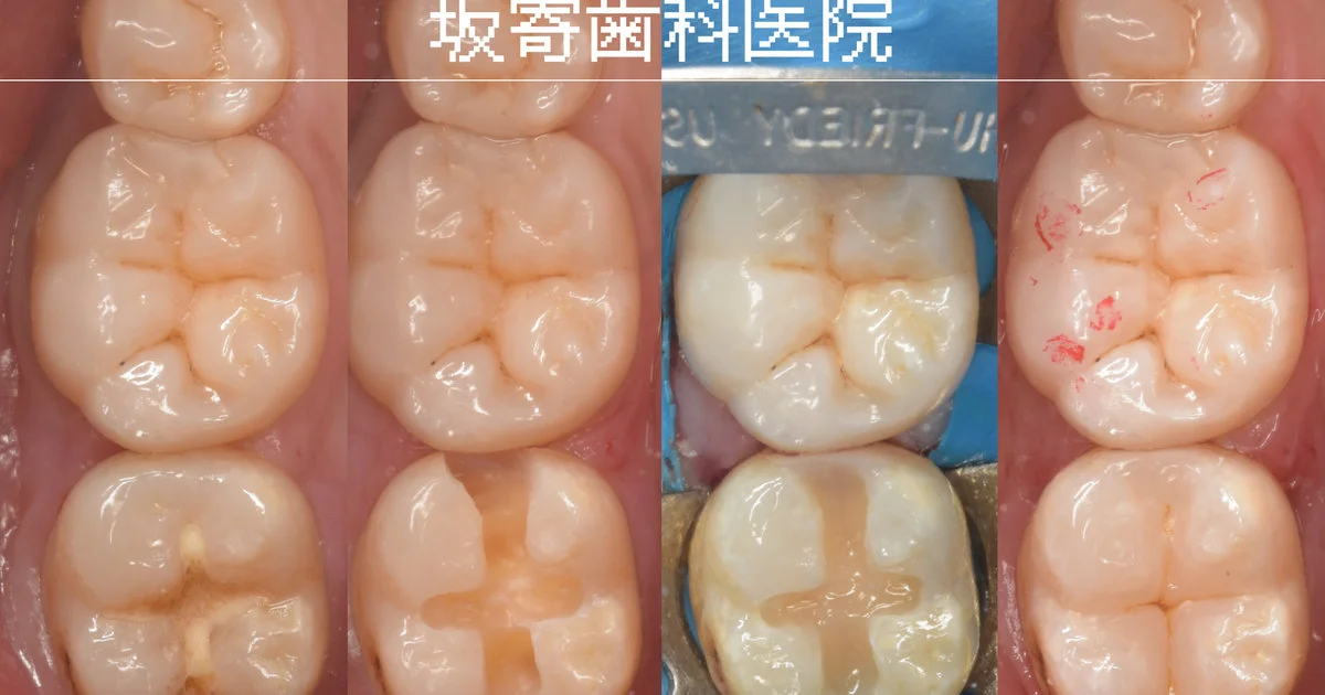 ブログ・お役立ち情報｜坂寄歯科医院（取手市藤代）