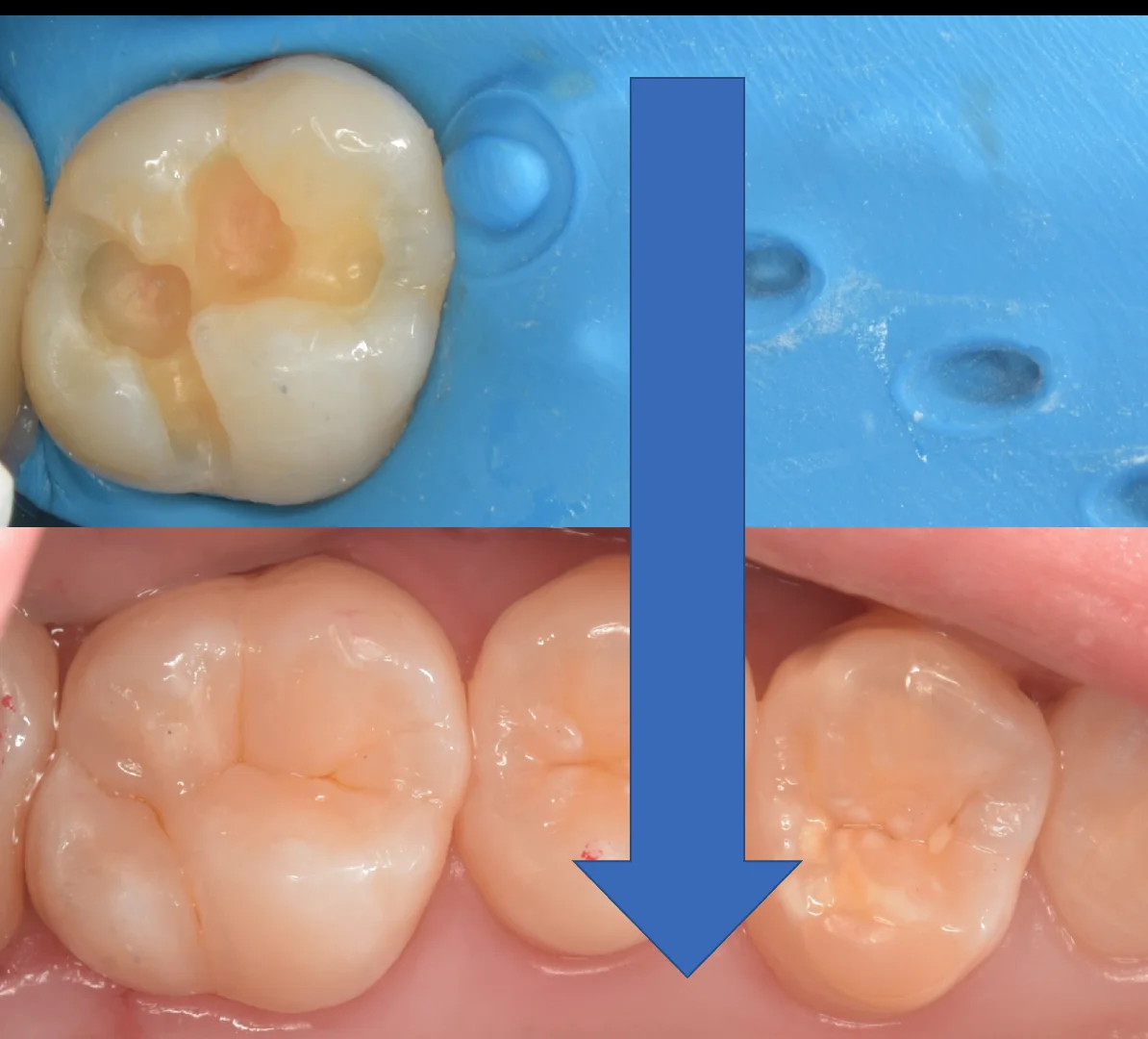 自費の白い詰め物。|坂寄歯科医院(取手市藤代) - 画像5