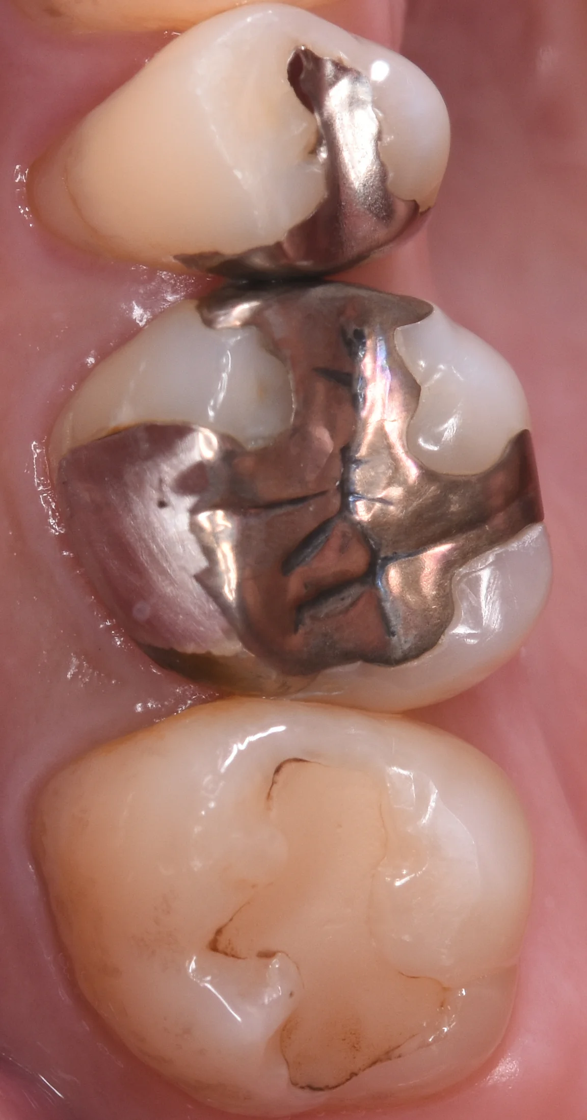 金属を白い詰め物に。|坂寄歯科医院(取手市藤代)