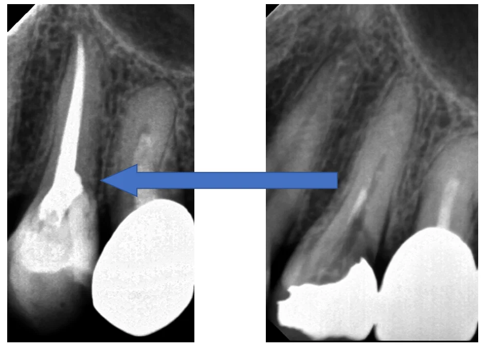 神経の治療⑤|坂寄歯科医院(取手市藤代) - 画像5