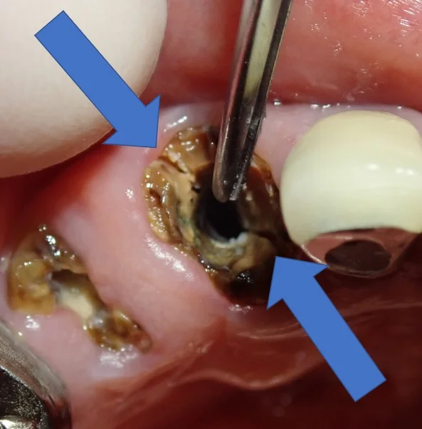 メタルコアによる歯根破折｜坂寄歯科医院（取手市藤代） - 画像3