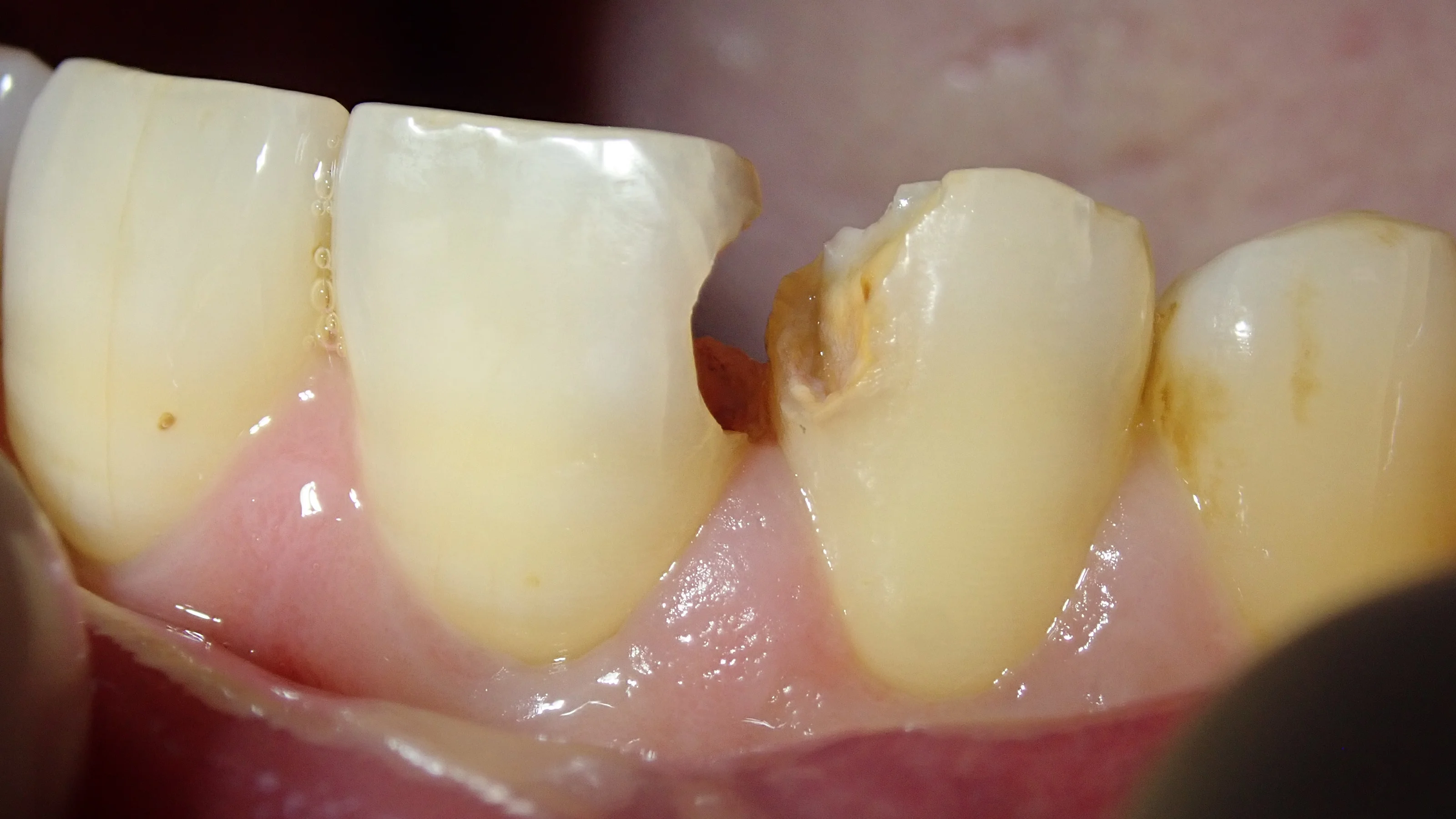 前歯の白い詰め物｜坂寄歯科医院（取手市藤代） - 画像3