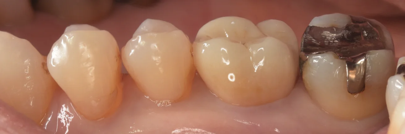 虫歯の治療後セラミックの被せ物に。｜坂寄歯科医院（取手市藤代） - 画像4