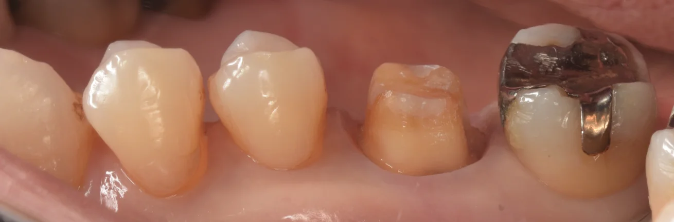 虫歯の治療後セラミックの被せ物に。｜坂寄歯科医院（取手市藤代） - 画像3