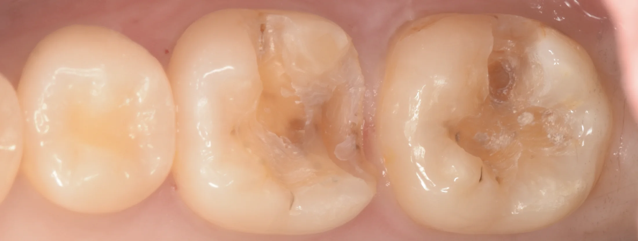 歯科医師の方のCAD/CAMインレーを治療。|坂寄歯科医院(取手市藤代) - 画像2