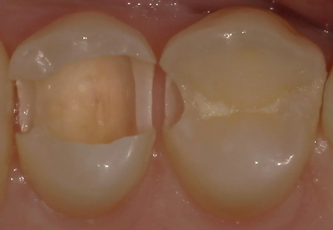 歯科医師の方の虫歯治療。|坂寄歯科医院(取手市藤代) - 画像3