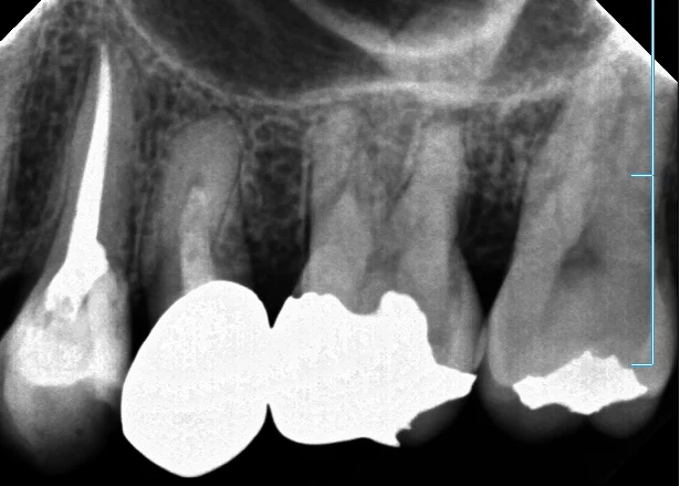 神経の治療⑤|坂寄歯科医院(取手市藤代) - 画像4