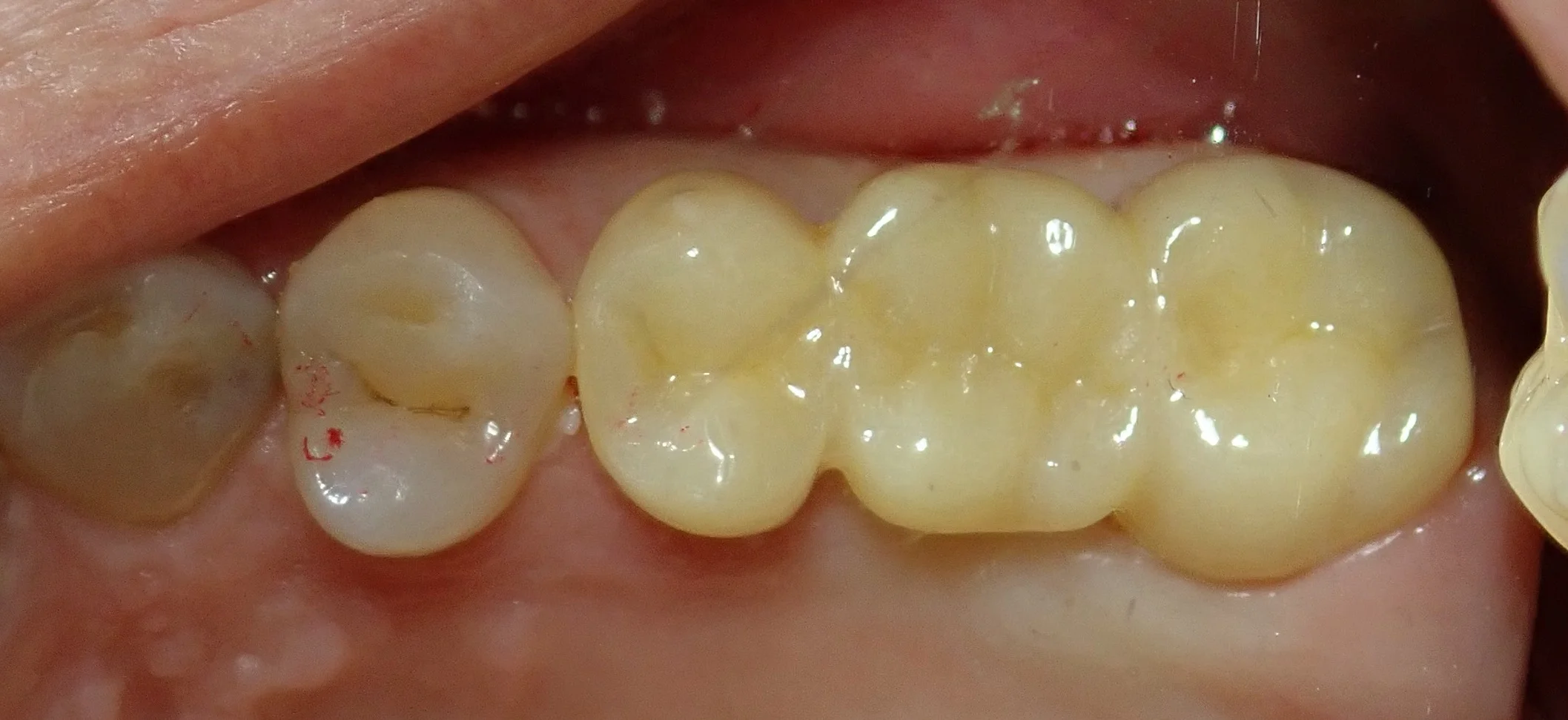 奥歯のセラミックブリッジ|坂寄歯科医院(取手市藤代) - 画像4