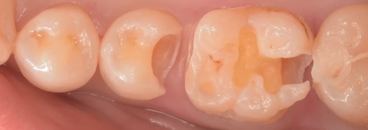 三鷹より来院された方|坂寄歯科医院(取手市藤代) - 画像5