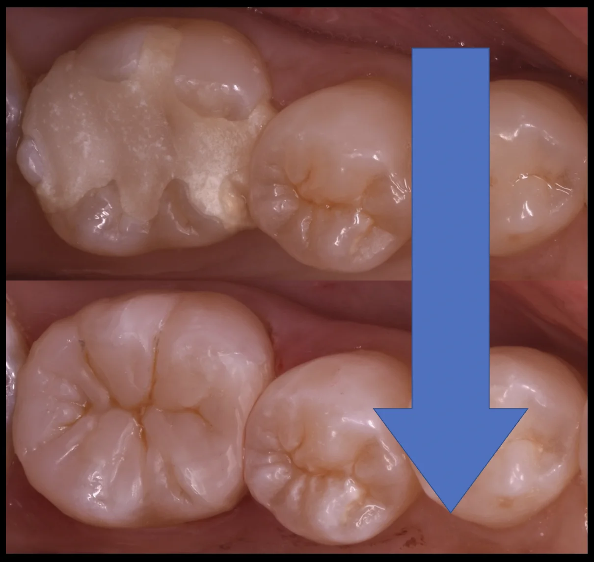 詰め物が脱離した所を即日で白い詰め物に。｜坂寄歯科医院（取手市藤代） - 画像5