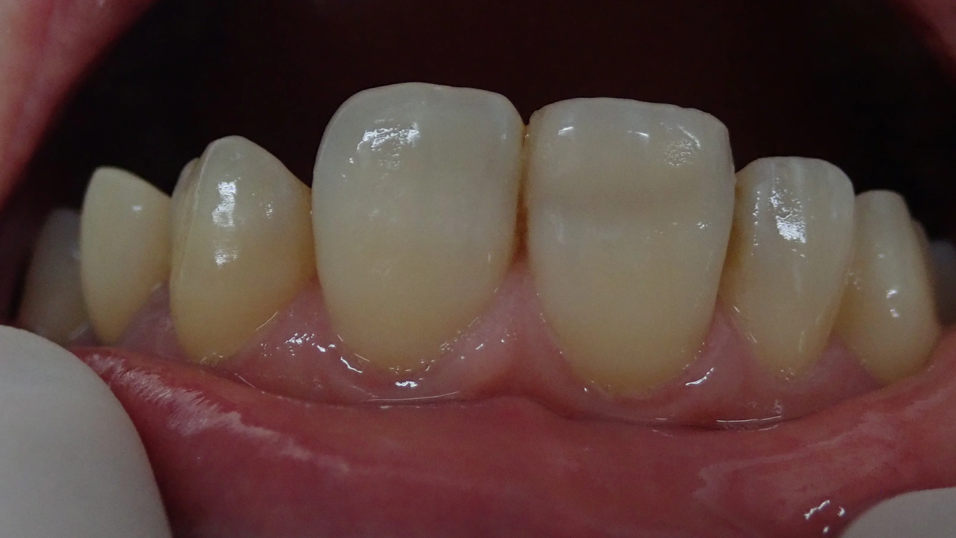 前歯ダイレクトボンディング②|坂寄歯科医院(取手市藤代) - 画像3