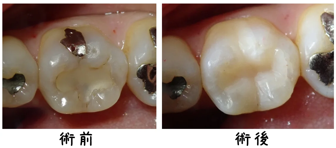 コンポジットレジン|坂寄歯科医院(取手市藤代) - 画像5