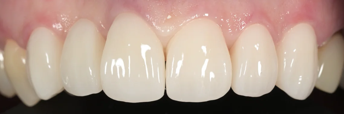 審美治療：セラミック｜坂寄歯科医院（取手市藤代） - 画像3