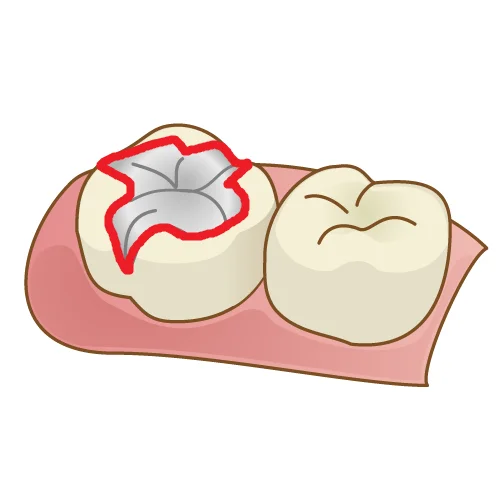 歯を可及的に温存したブリッジ|坂寄歯科医院(取手市藤代) - 画像4