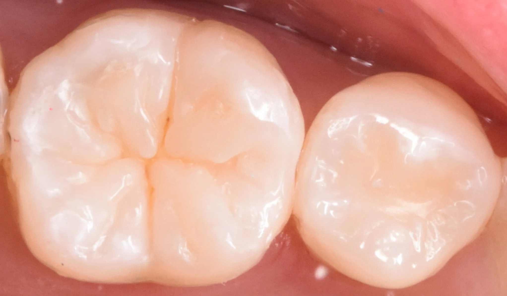 奥歯を白い詰め物で治療。|坂寄歯科医院(取手市藤代) - 画像3