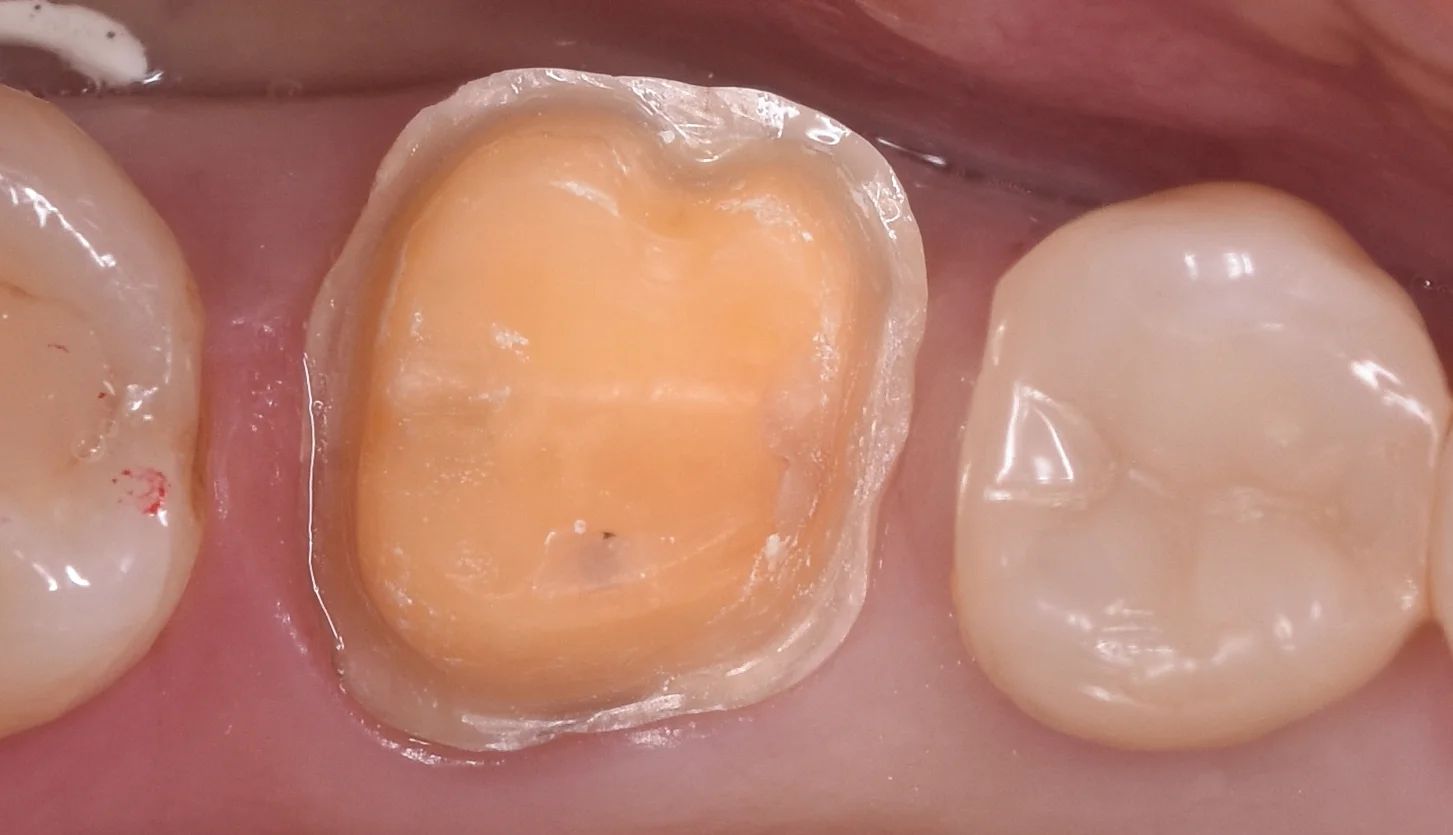 歯の亀裂で痛みが出たため、被せ物に。|坂寄歯科医院(取手市藤代)