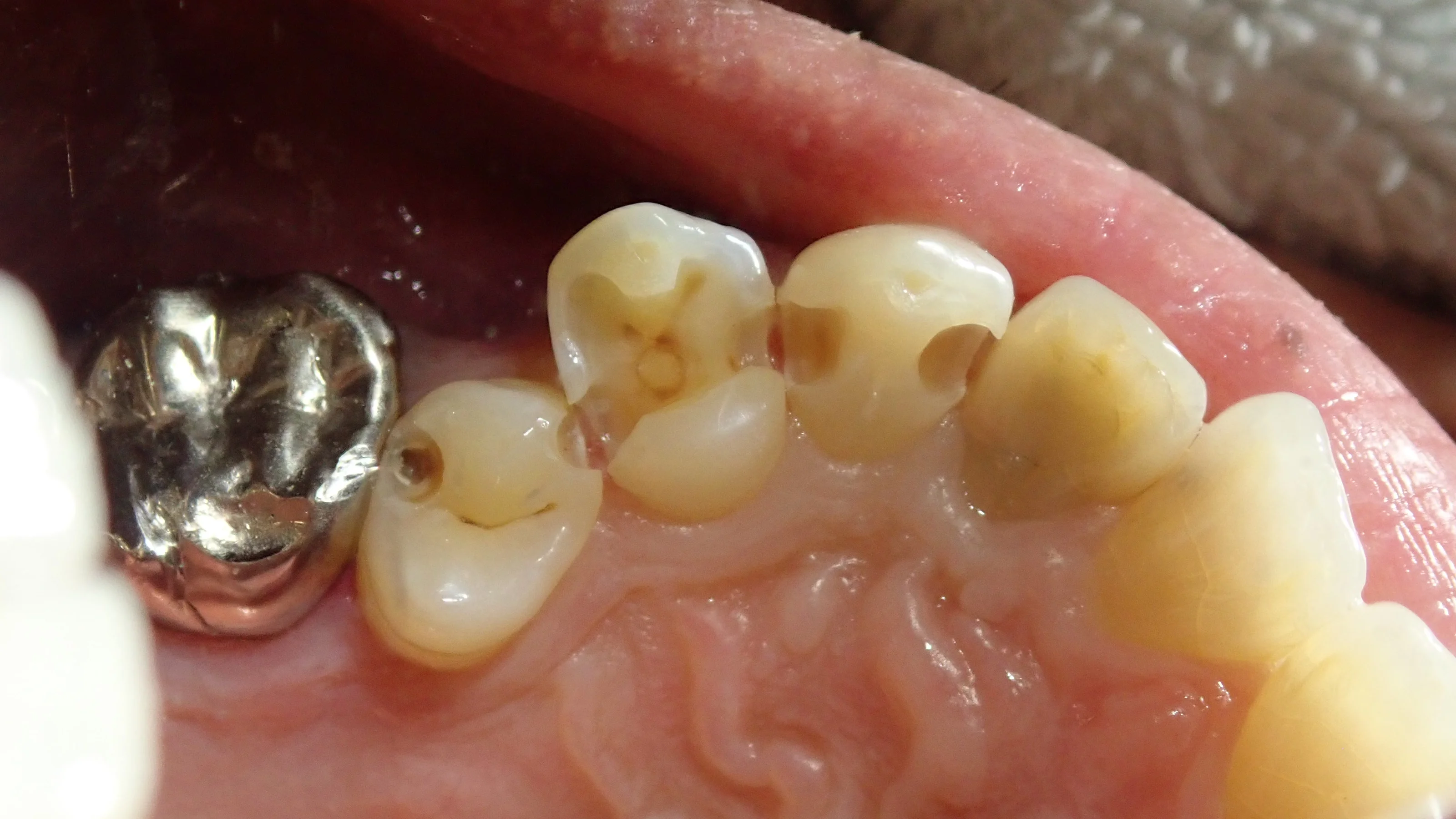 左上3本まとめてダイレクトボンディング｜坂寄歯科医院（取手市藤代） - 画像3