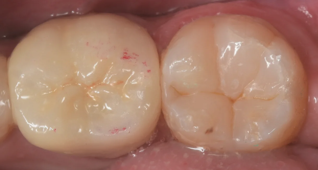 古い白い詰め物を詰め直し｜坂寄歯科医院（取手市藤代） - 画像4