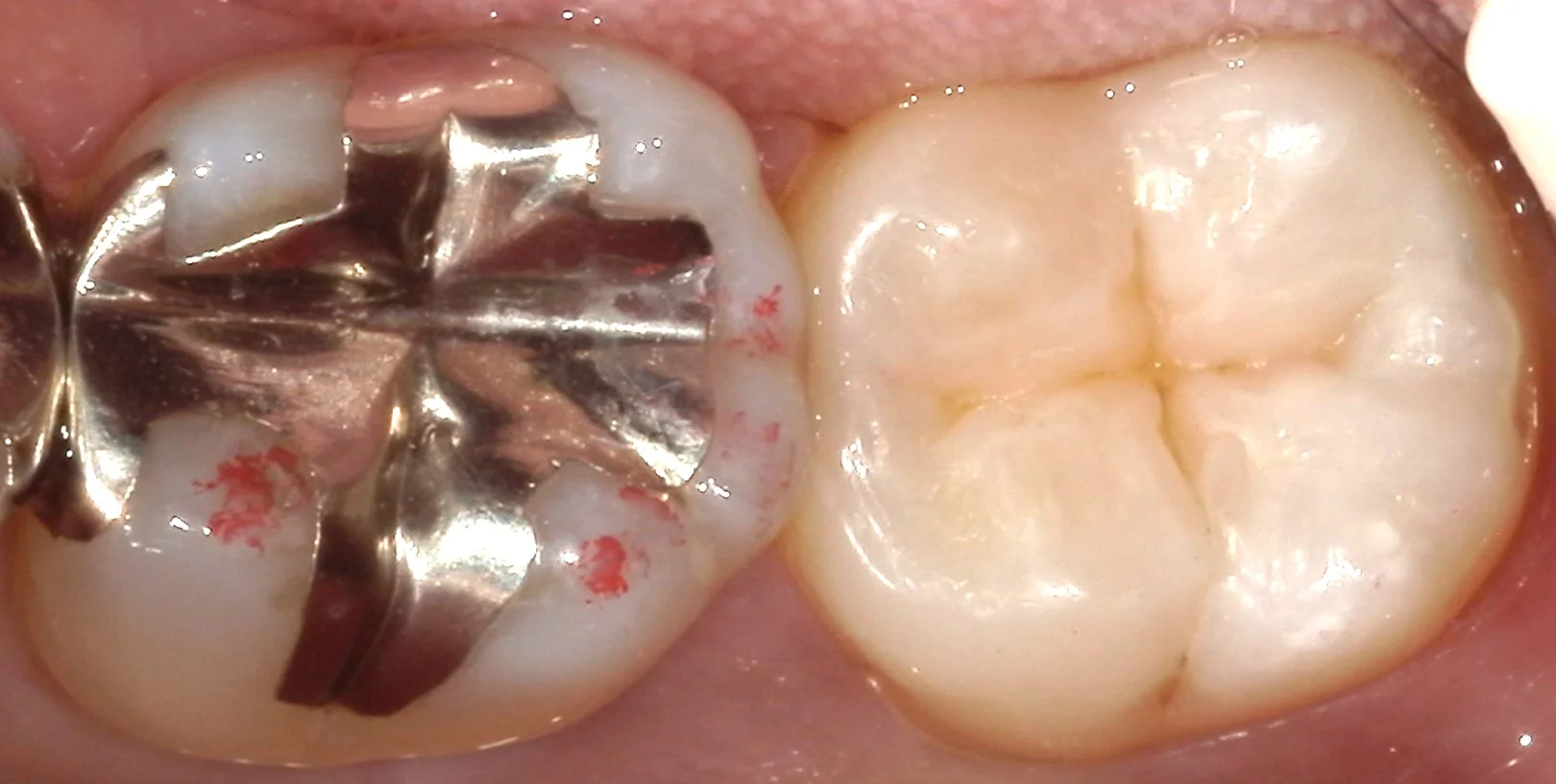 奥歯の自費の白い詰め物。術後数週間後もあります。|坂寄歯科医院(取手市藤代) - 画像5