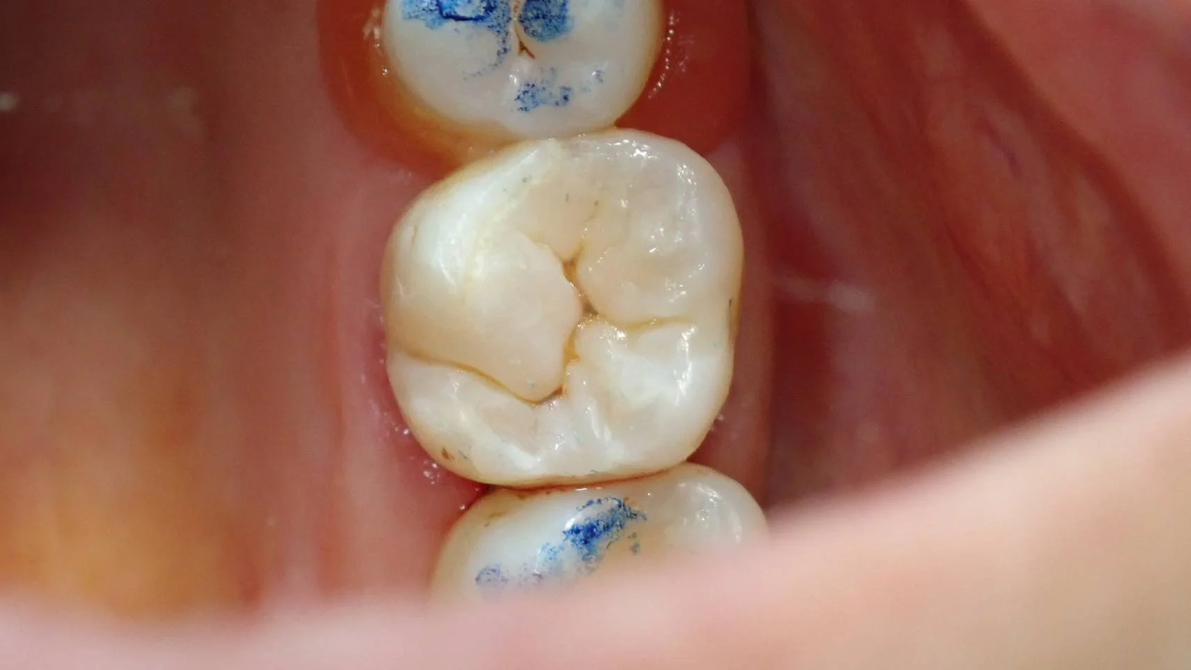 ダイレクトボンディング⑤｜坂寄歯科医院（取手市藤代） - 画像2