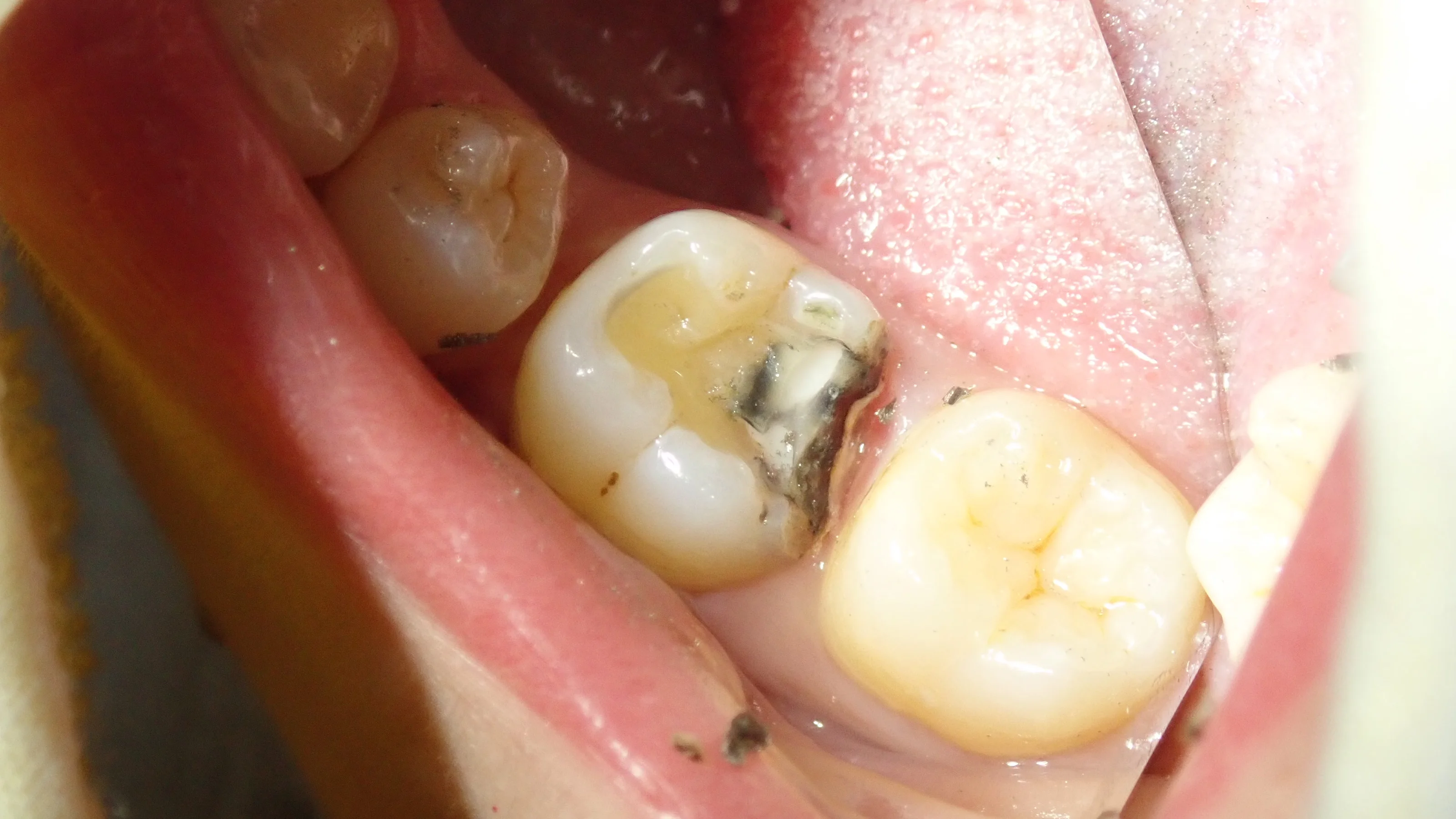 奥2本のダイレクトボンディング|坂寄歯科医院(取手市藤代) - 画像5