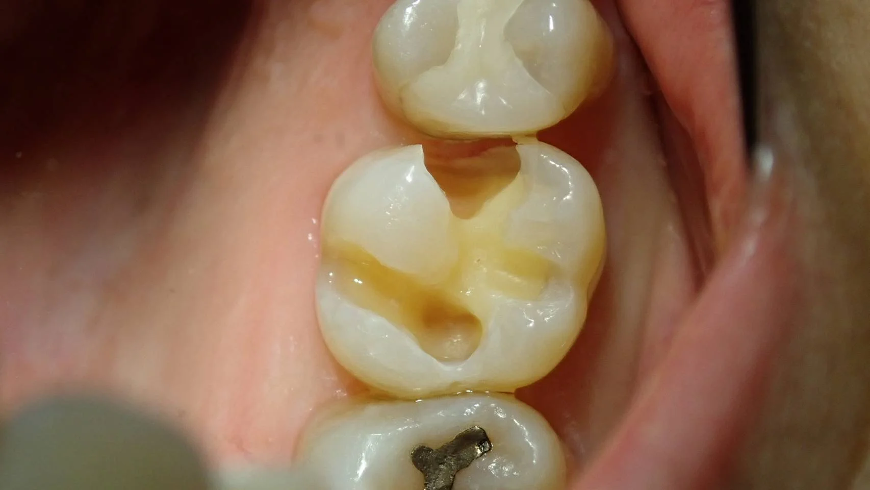 ダイレクトボンディング⑥｜坂寄歯科医院（取手市藤代）