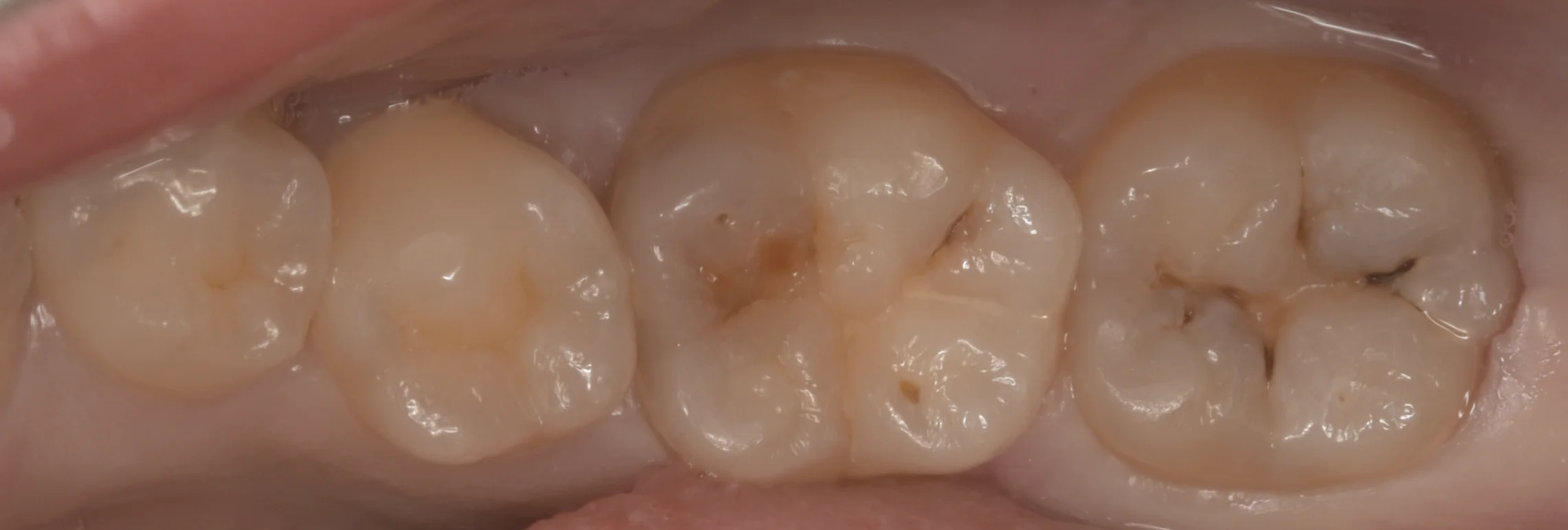 浦安から来た方をダイレクトボンディングで。｜坂寄歯科医院（取手市藤代）