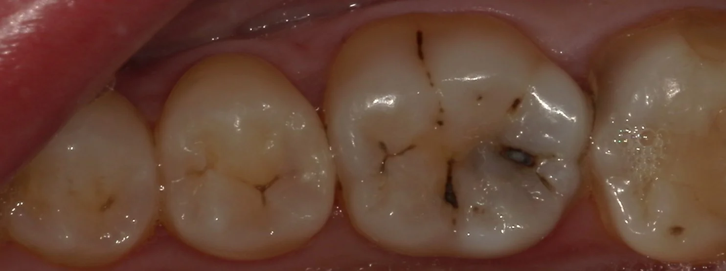 歯科医師の方をダイレクトボンディングにて治療。｜坂寄歯科医院（取手市藤代）
