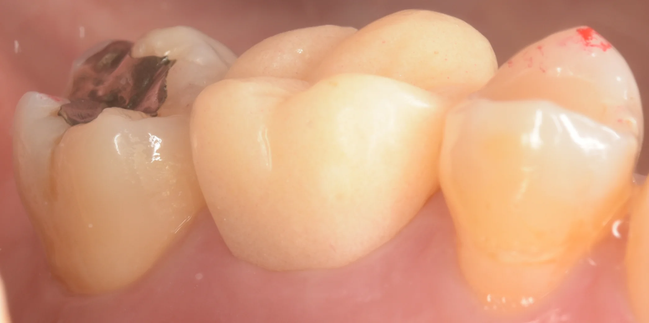 セラミックの被せ物｜坂寄歯科医院（取手市藤代）