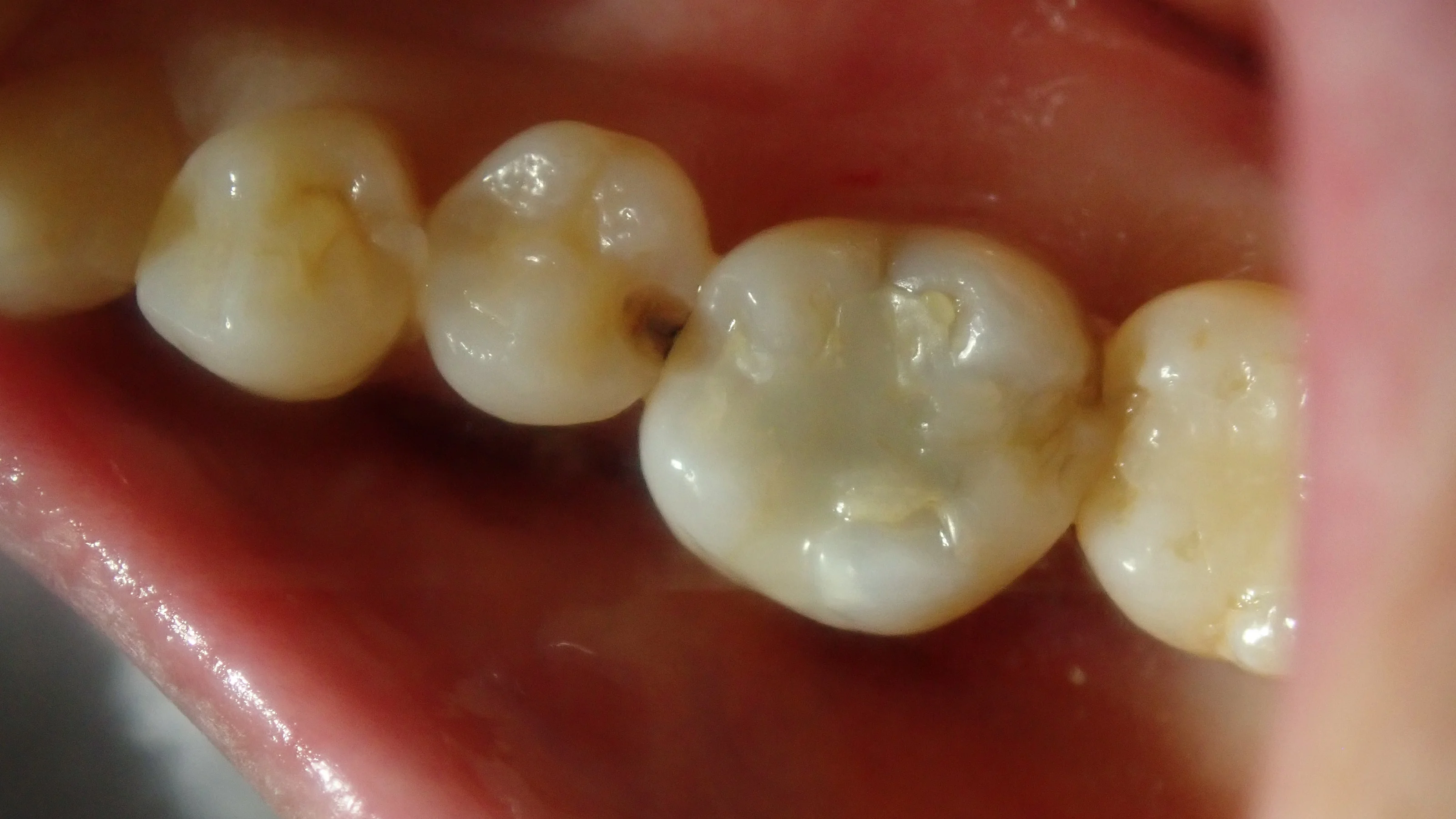 ダイレクトボンディング⑦|坂寄歯科医院(取手市藤代) - 画像2