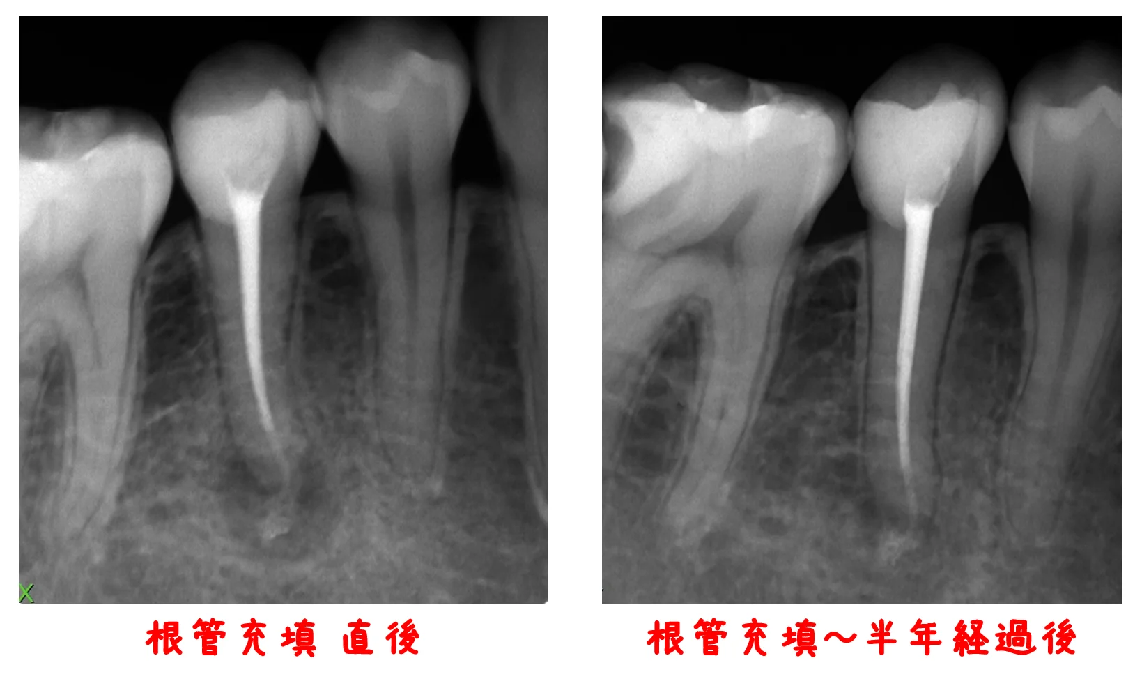 神経の治療④|坂寄歯科医院(取手市藤代)