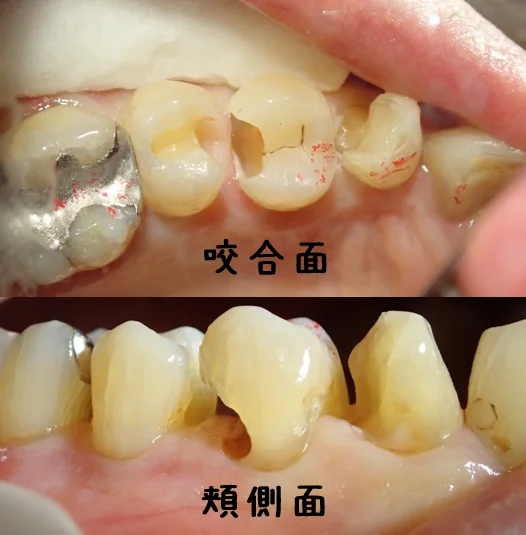 3本連続ダイレクトボンディング|坂寄歯科医院(取手市藤代) - 画像3