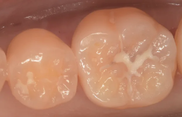 様子を見ていた所が進んだため治療介入。|坂寄歯科医院(取手市藤代)