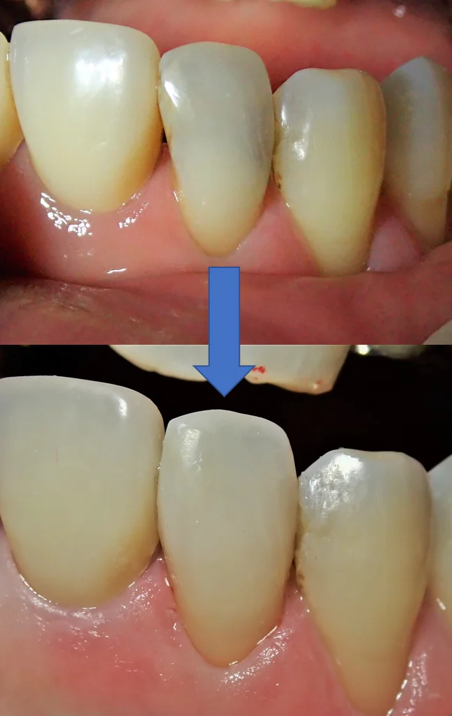 前歯ダイレクトボンディング｜坂寄歯科医院（取手市藤代） - 画像6