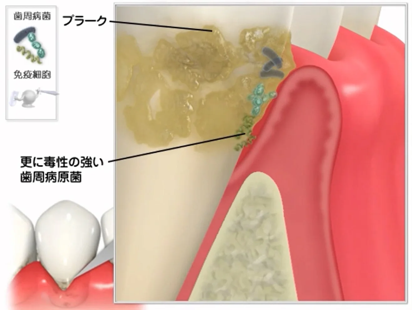 Q&A~歯周病ってなに?②~|坂寄歯科医院(取手市藤代)