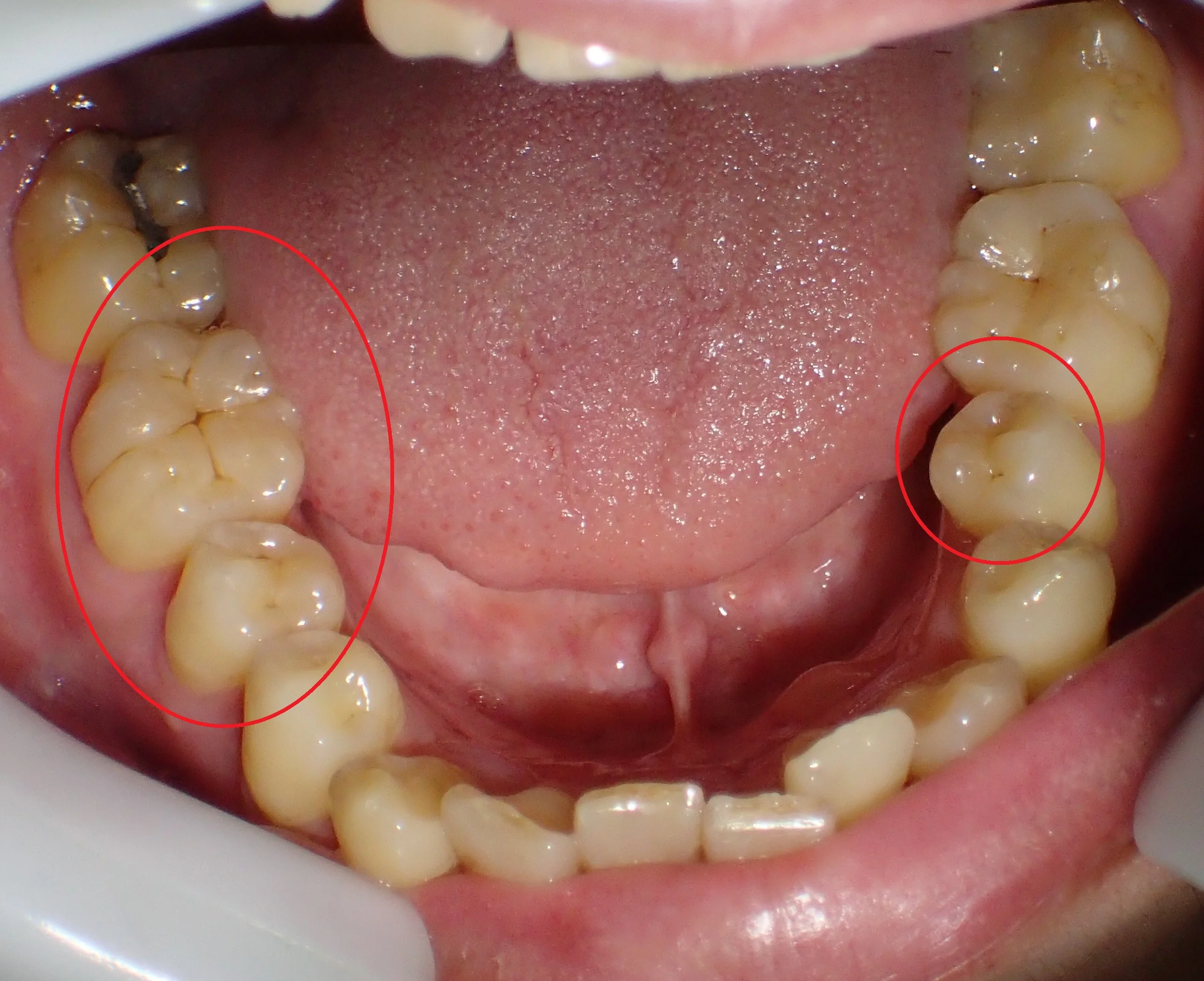 ダイレクトボンディングによる治療｜坂寄歯科医院（取手市藤代） - 画像4