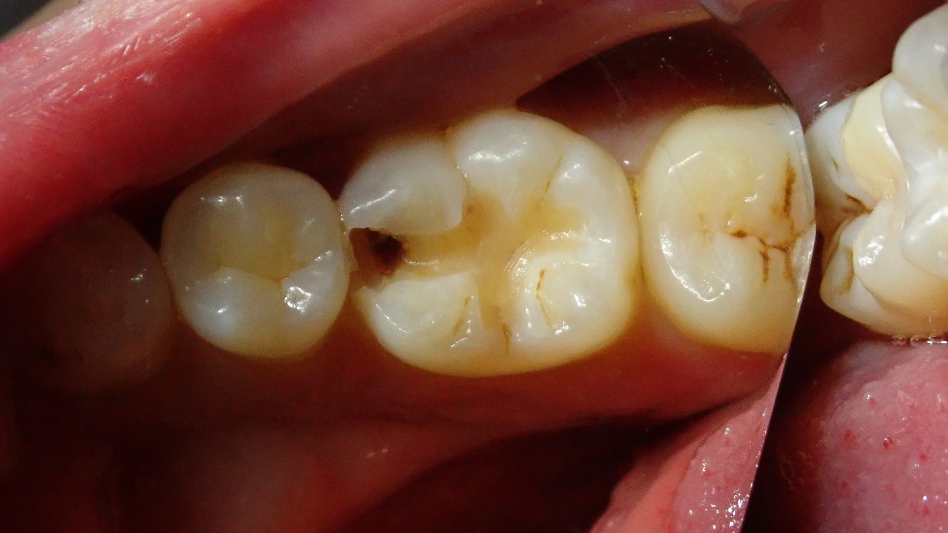 ダイレクトボンディング⑧|坂寄歯科医院(取手市藤代) - 画像3