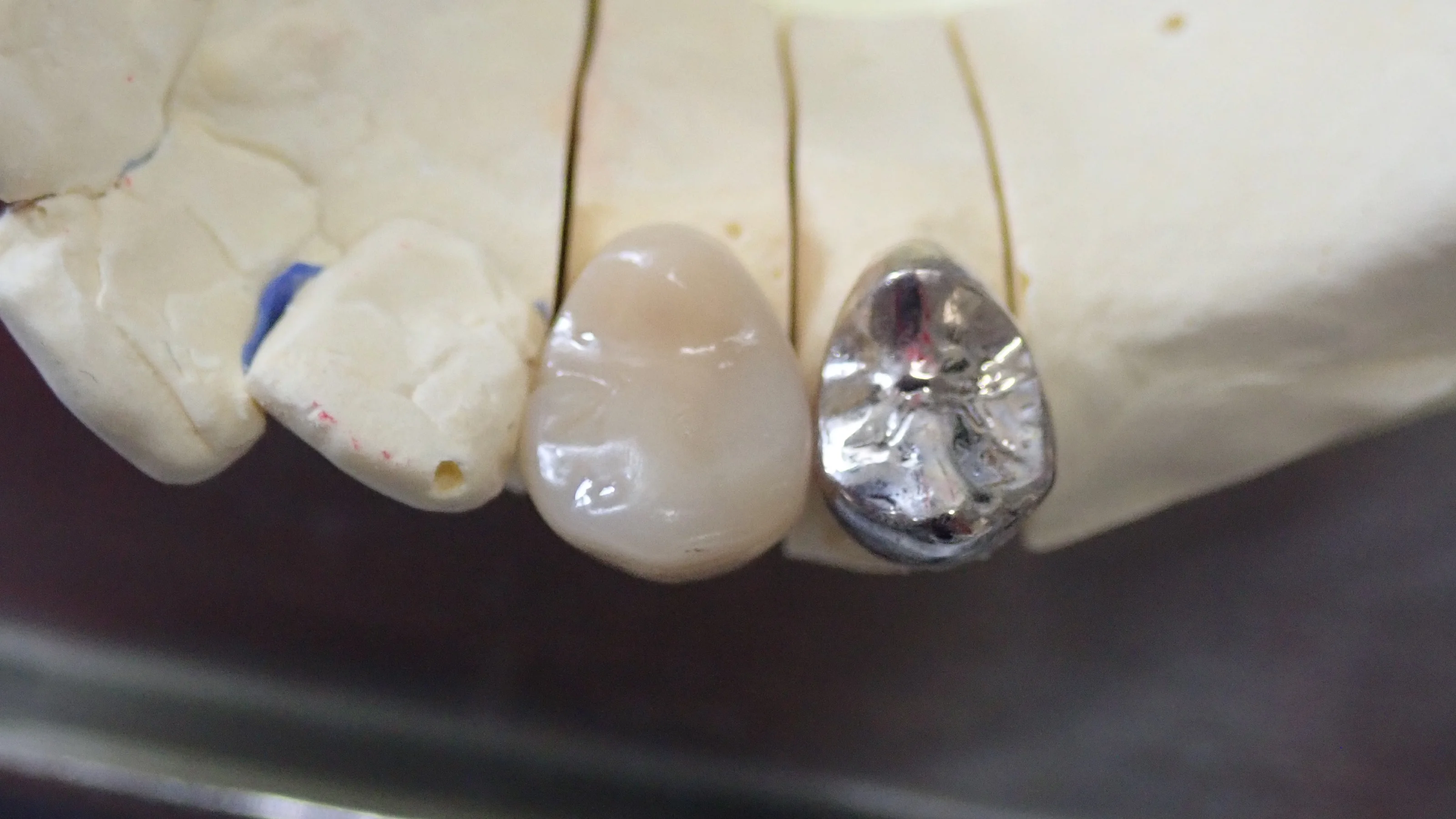 硬質レジンジャケット冠|坂寄歯科医院(取手市藤代) - 画像3