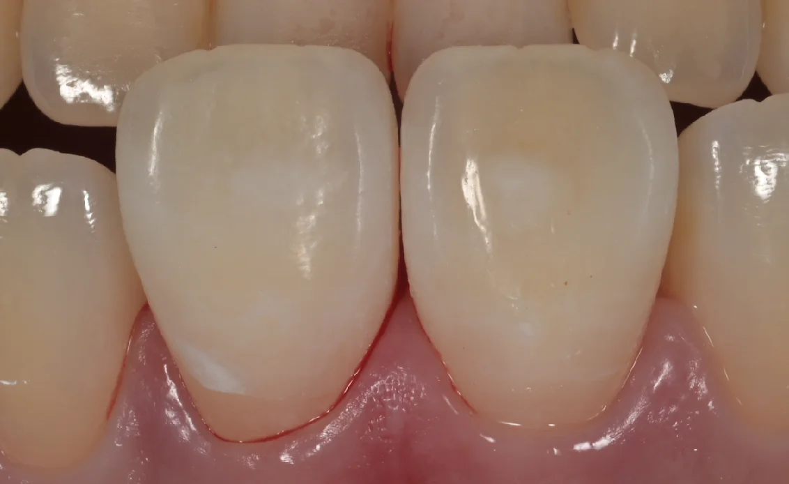 ICON治療。|坂寄歯科医院(取手市藤代) - 画像6