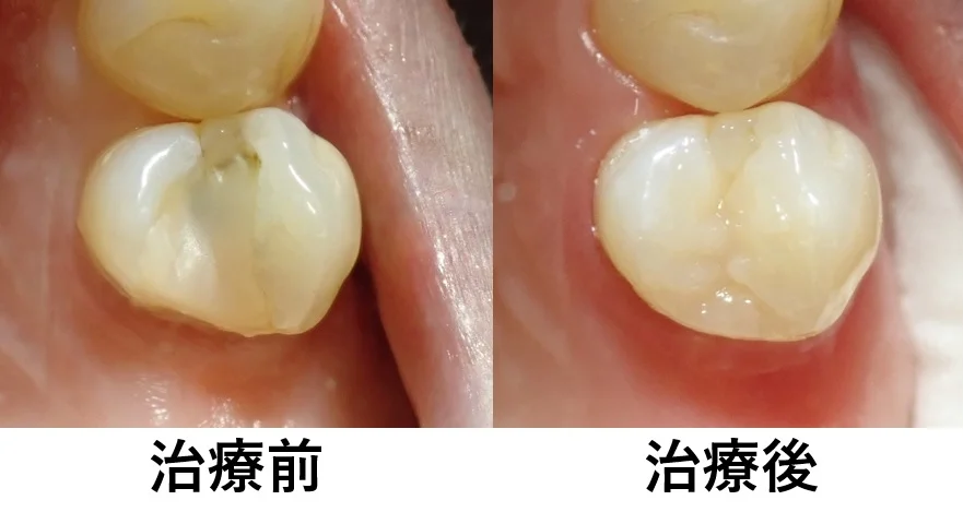 ダイレクトボンディング④|坂寄歯科医院(取手市藤代) - 画像9