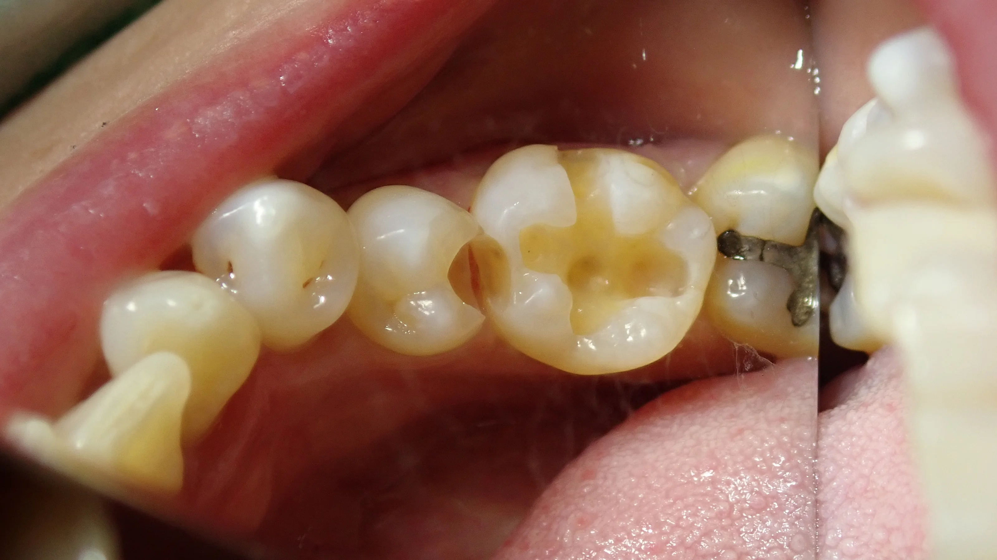 下の奥歯2本の詰め物|坂寄歯科医院(取手市藤代) - 画像3