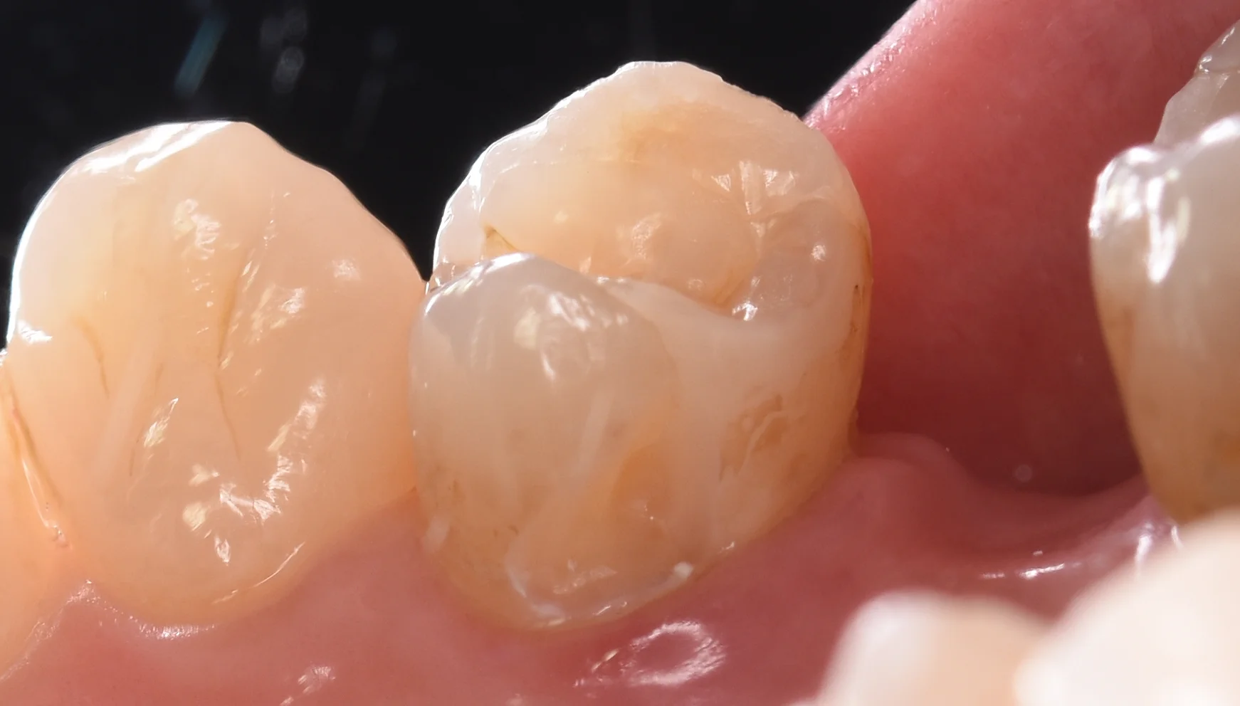 ダイレクトボンディング術後4年での補修修復|坂寄歯科医院(取手市藤代) - 画像4