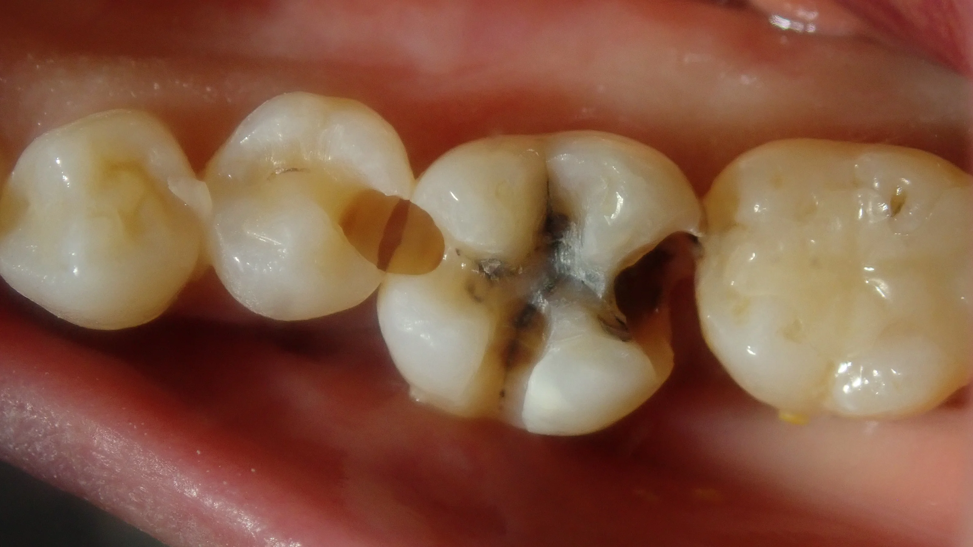 ダイレクトボンディング⑦|坂寄歯科医院(取手市藤代) - 画像3