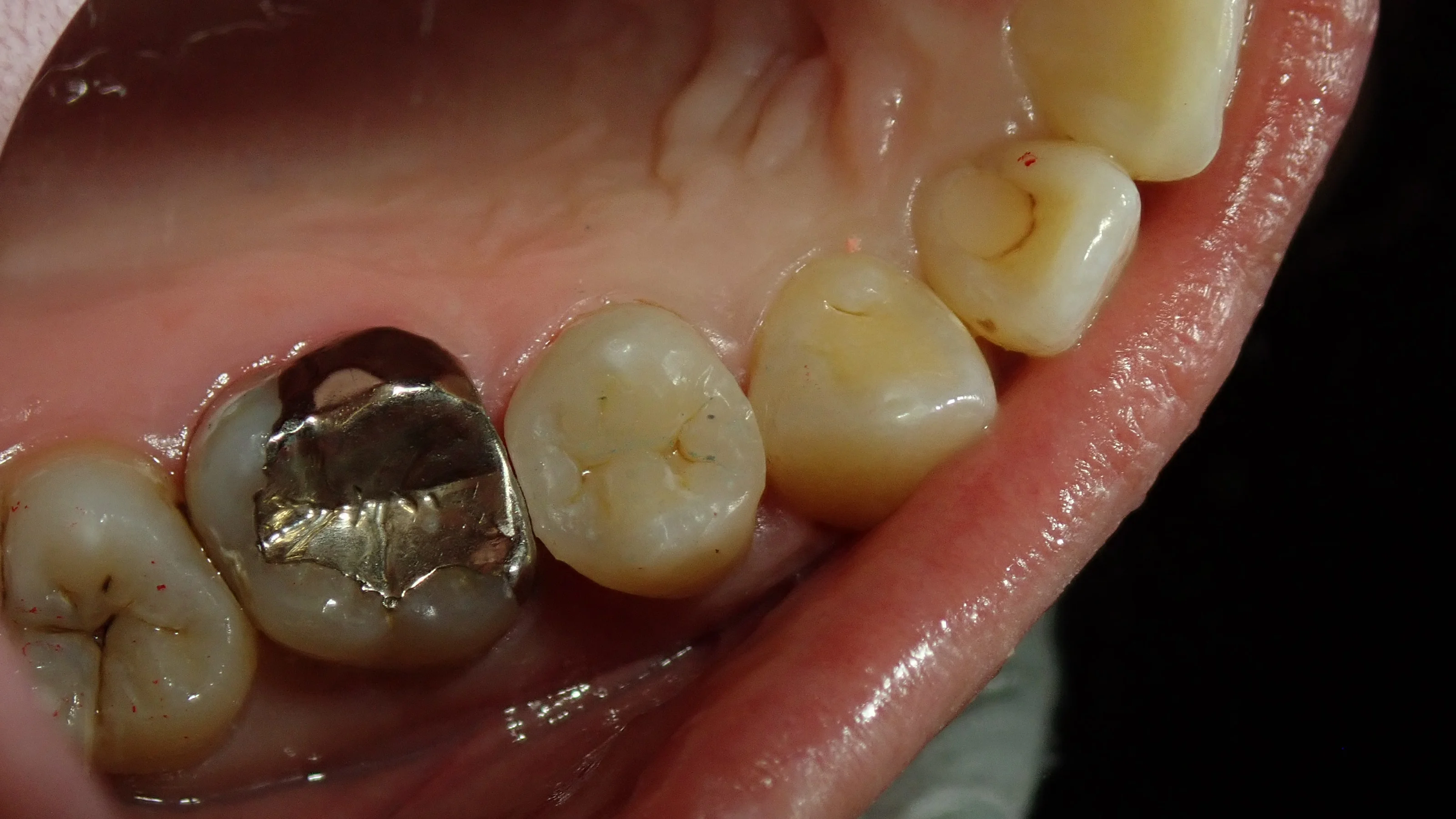 犬歯と奥歯の白い詰め物｜坂寄歯科医院（取手市藤代） - 画像4