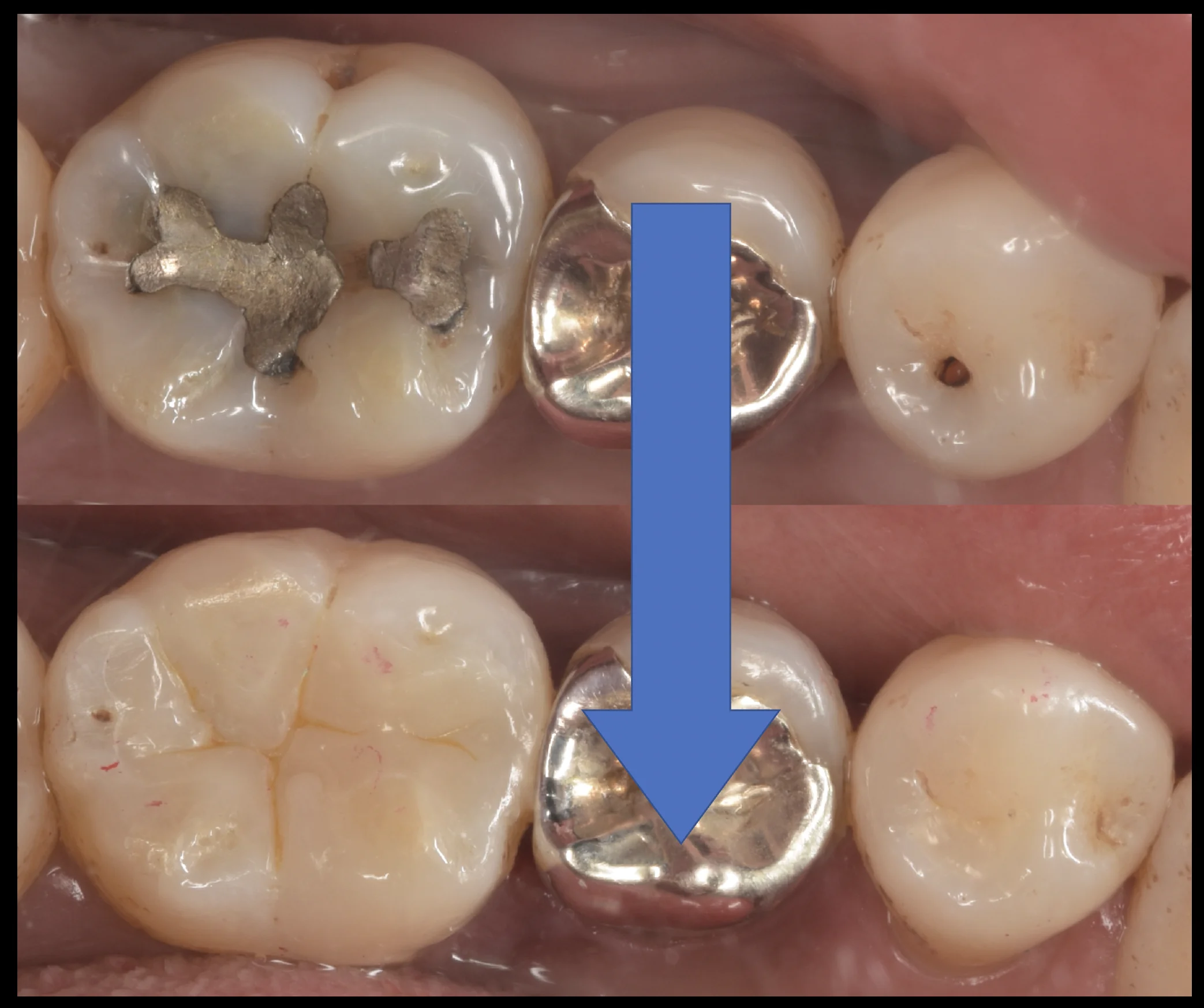 古い金属にできた虫歯をその日のうちに白い詰め物で。｜坂寄歯科医院（取手市藤代） - 画像5